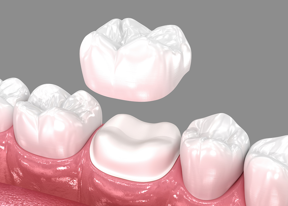 Dental Crowns
