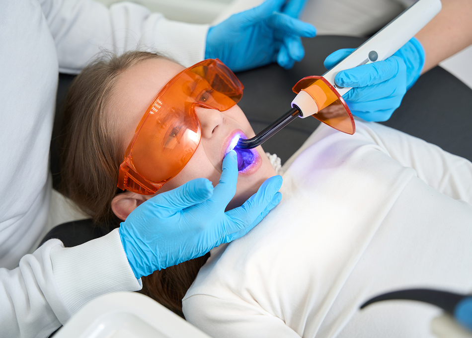 Dental Fillings