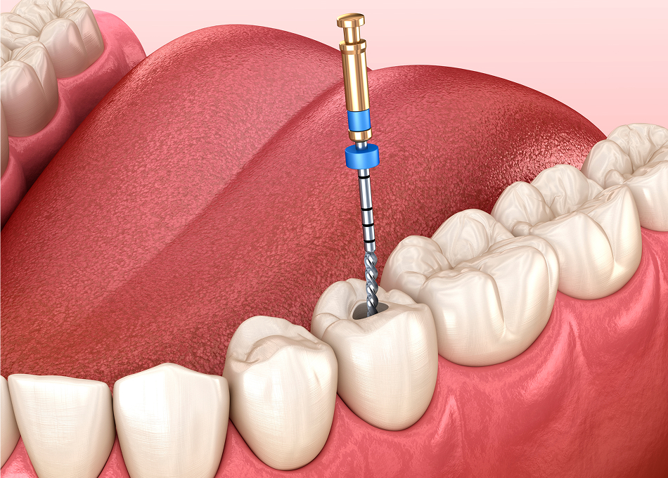Root Canal Treatment