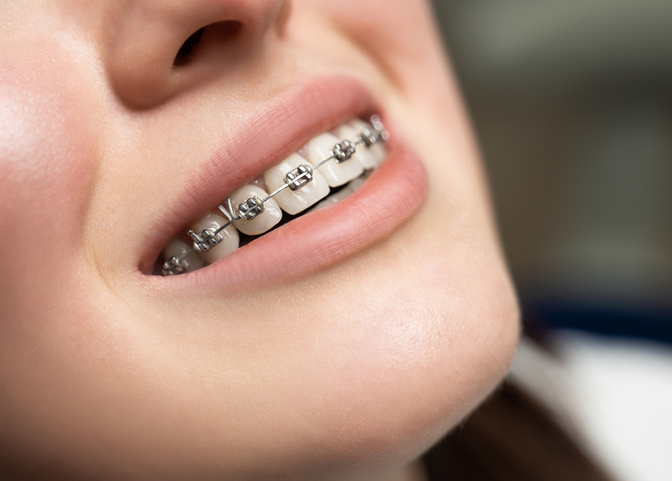 Ceramic Braces
