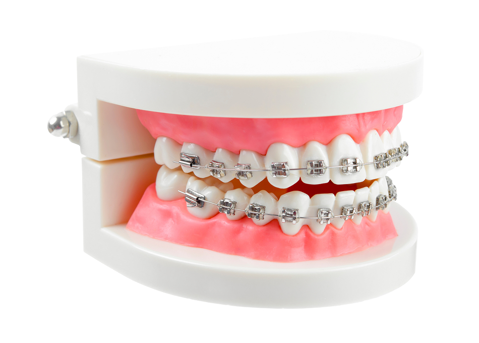 Traditional Braces
